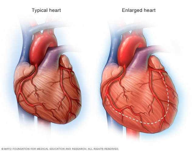 Corazón dilatado // Middlesex Health