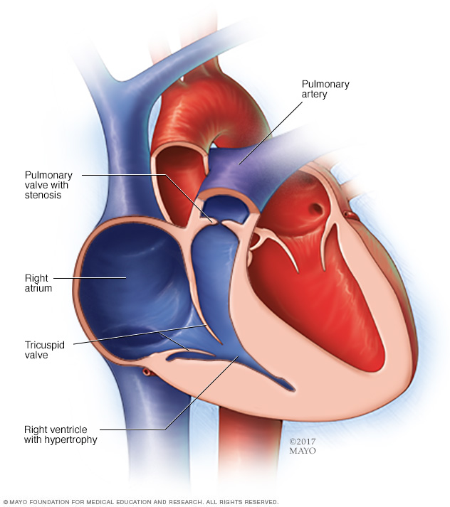 Estenosis pulmonar