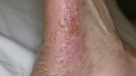 Pustular psoriasis