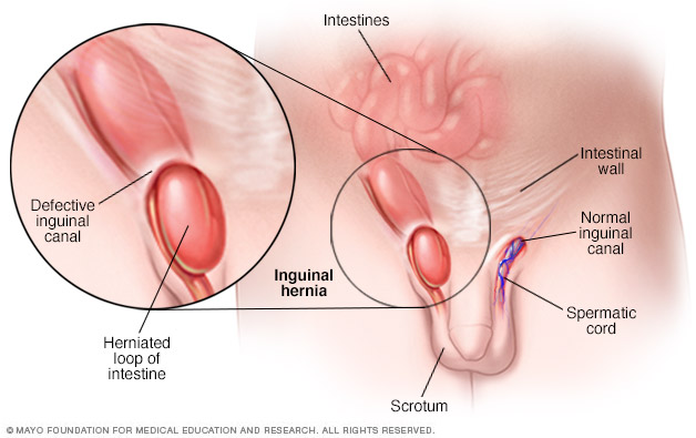 Inguinal hernia