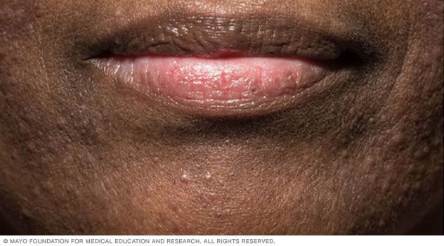 Dermatitis perioral