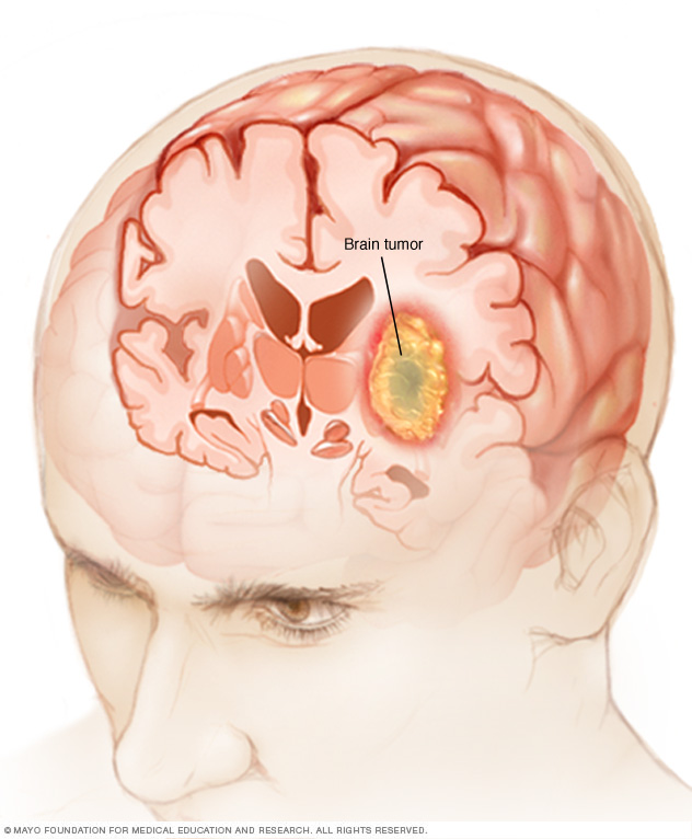 Tumor cerebral