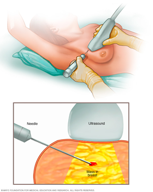 Breast cancer // Middlesex Health