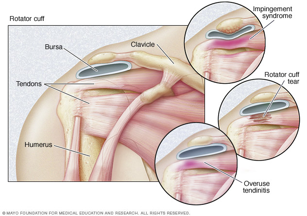 Rotator Cuff Pain  Advanced Orthopaedics & Sports Medicine