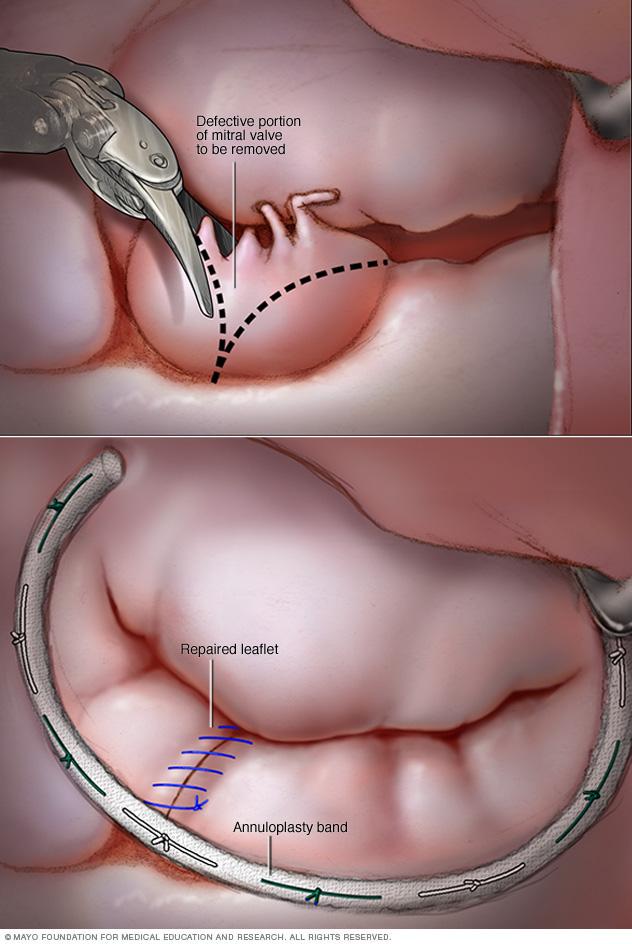 Reparación de la válvula mitral con cirugía robótica