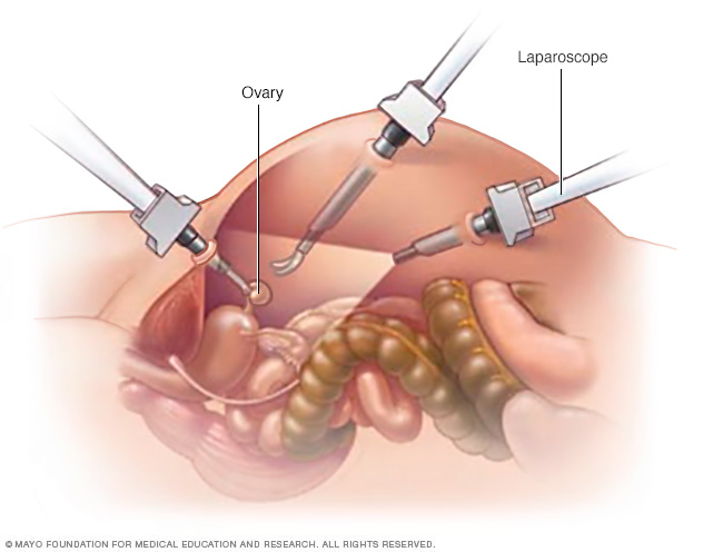 Laparoscopic surgery