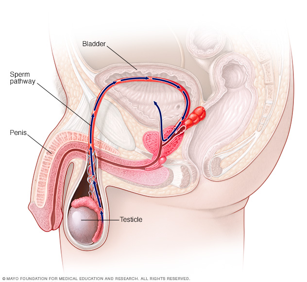 Retrograde ejaculation