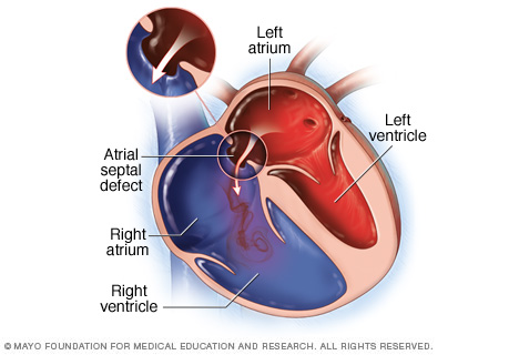 An atrial septal defect