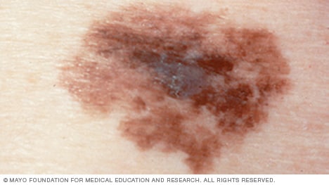 Melanoma