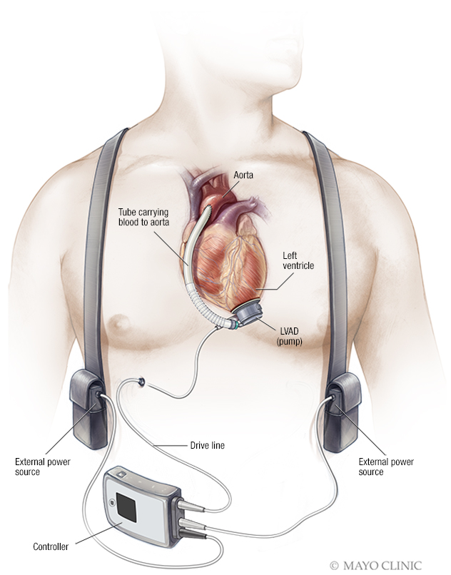 LVAD Back Pack