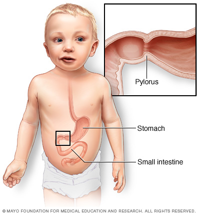 The location of the pylorus