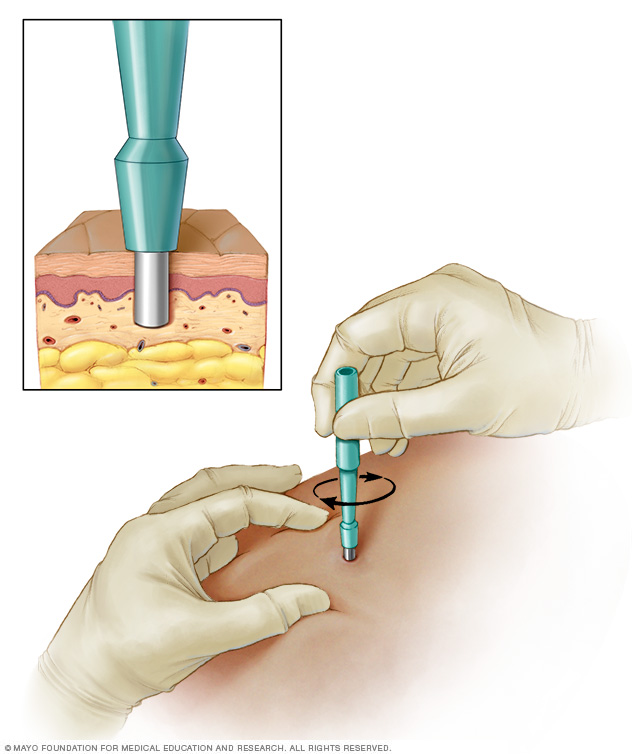 A closeup of a punch biopsy shows the layers where tissue is removed. A larger image shows how the tool is placed against the skin and twisted in.