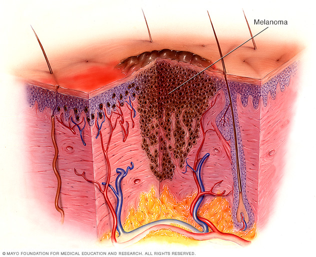 Our Skin Cells Can 'See' UV Rays, Tanning & Skin Cancer