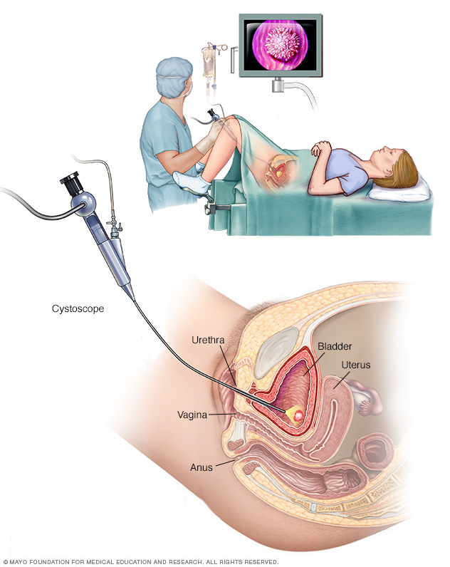 Urine Brown Discharge, Blood in the urine can look pink, red or  cola-colored.