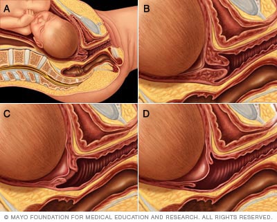 Cervical effacement and dilation 