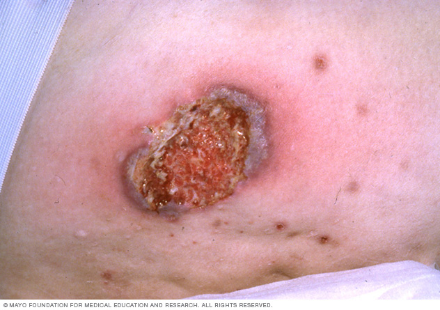 Advanced-stage pyoderma gangrenosum