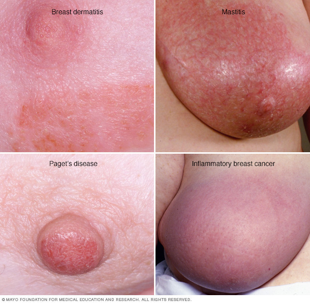 Breast rash // Middlesex Health