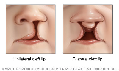 Labio leporino unilateral y bilateral