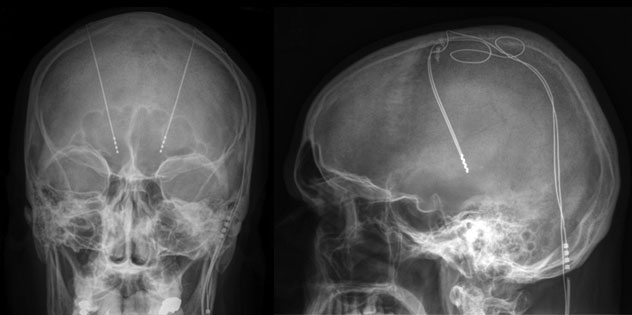 Estimulación cerebral profunda