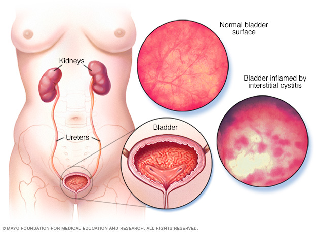 Do you feel burning or sharp pain in your bladder or urethra?