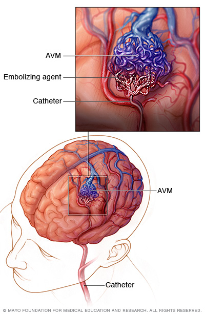 Endovascular embolization