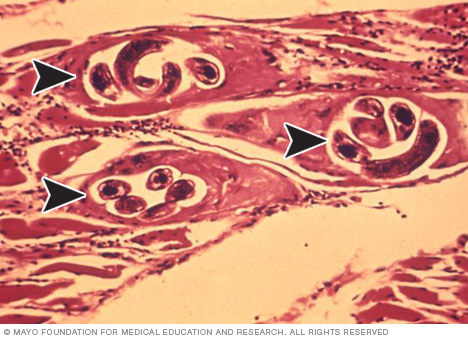 Vista microscópica de larvas de Trichinella en el tejido muscular