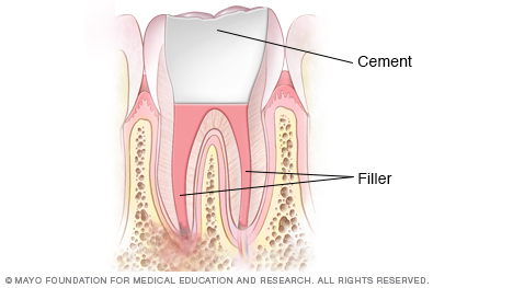 Illustration showing pulp chambers and root canal filled