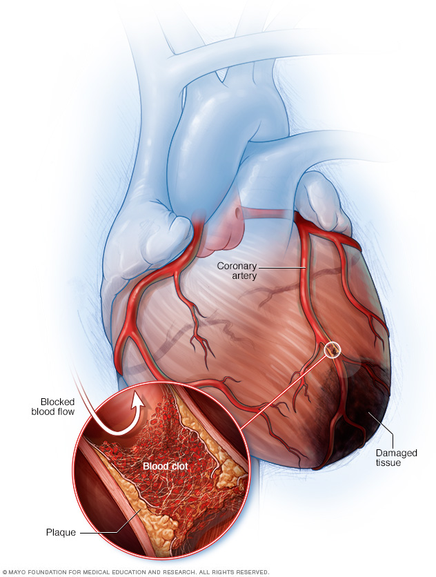 Blocked artery and injured tissue in a heart attack