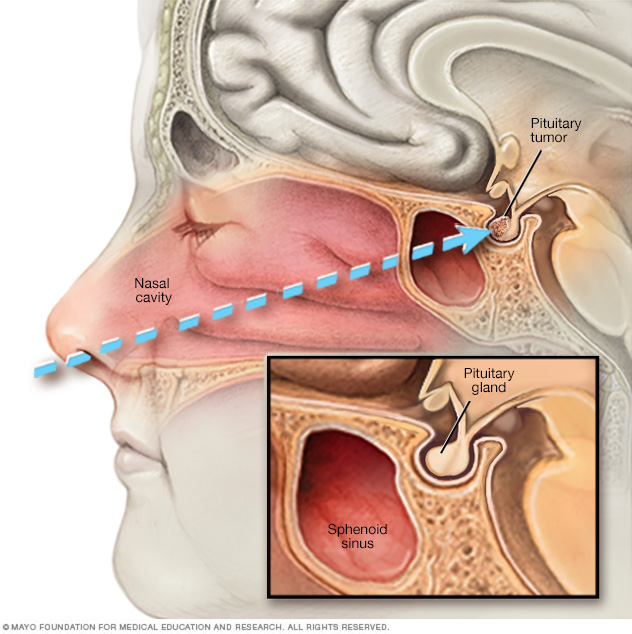 Cirugía transesfenoidal trasnasal endoscópica