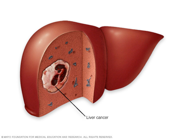 Hígado con cáncer