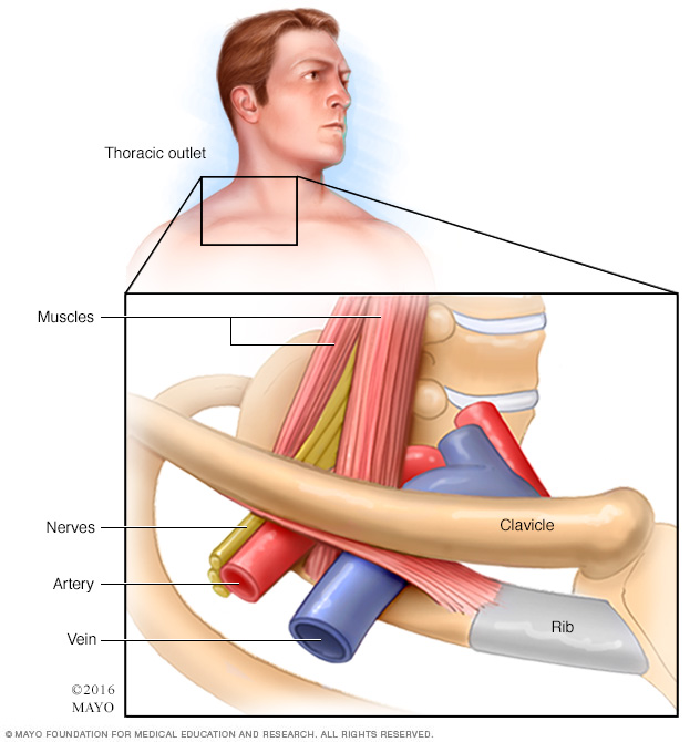 thoracic outlet syndrome exercises stretches