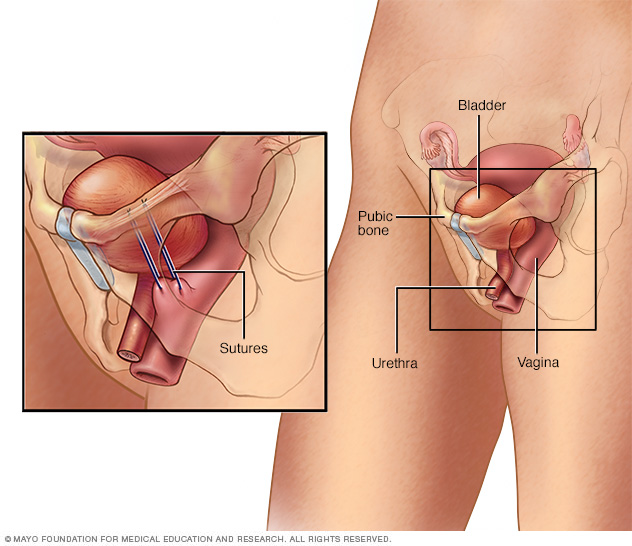 Bladder neck suspension procedure