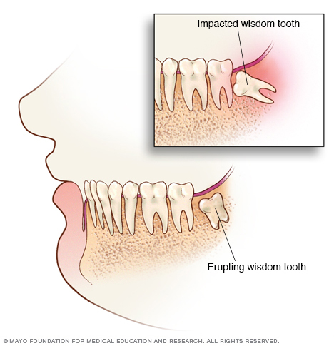 Impacted wisdom teeth