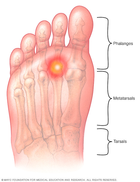 El dolor de la almohadilla del pie: causas y remedios