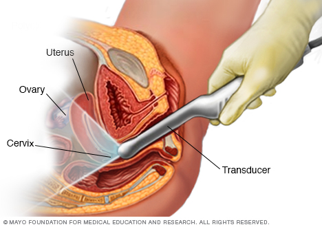 Ecografía transvaginal