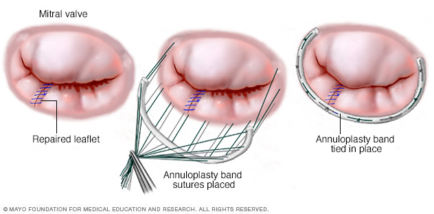 Una anuloplastia