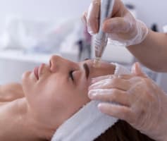 טיפול מיקרונידלינג