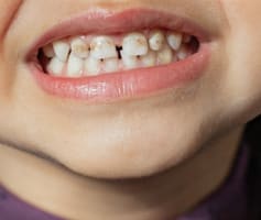 חוסר אמייל בשן