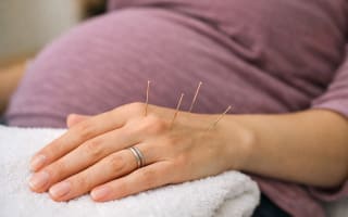 דיקור סיני לאישה בהריון