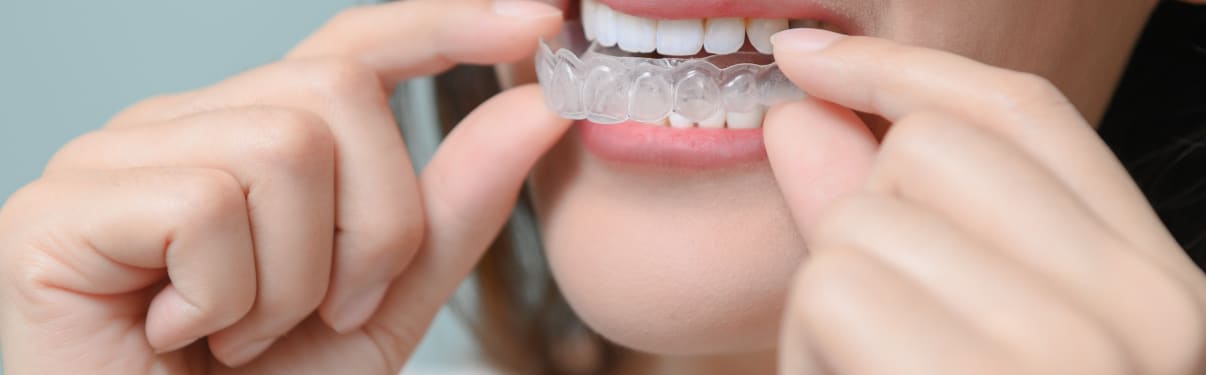 אינויזליין - אישה מרכיבה קשתיות שקופות של אינויזליין