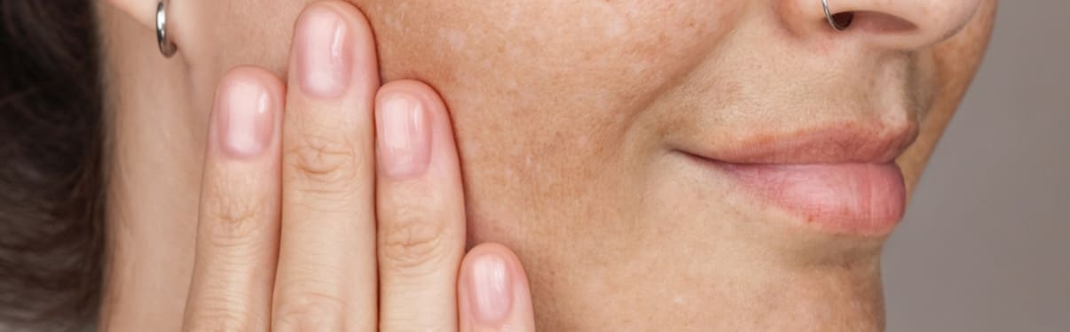 טיפול בפיגמנטציה בפנים