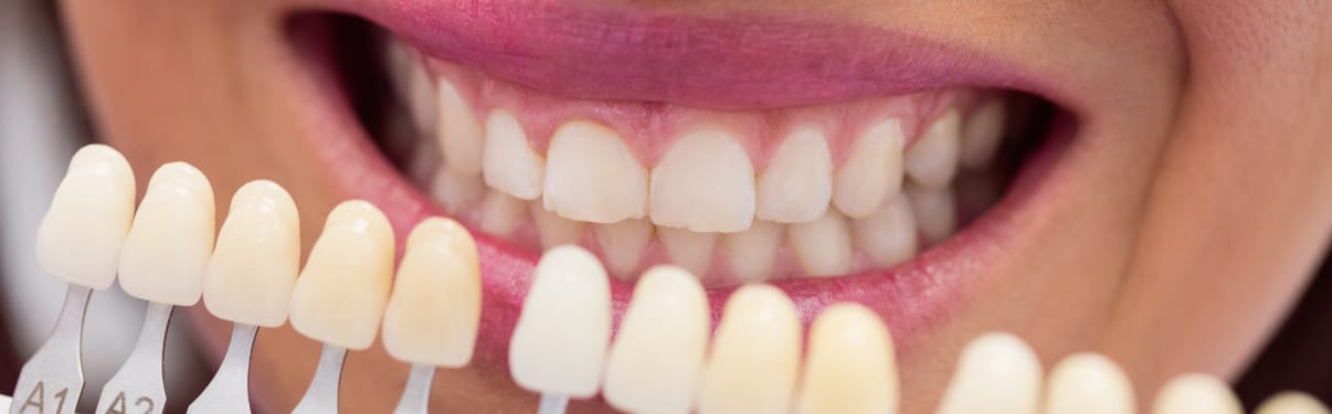 ציפוי לשיניים