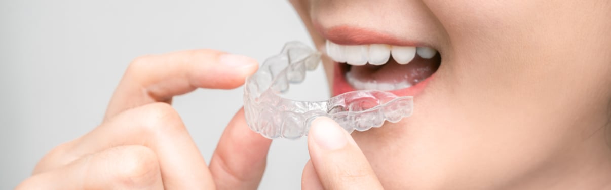 הלבנת שיניים בסד