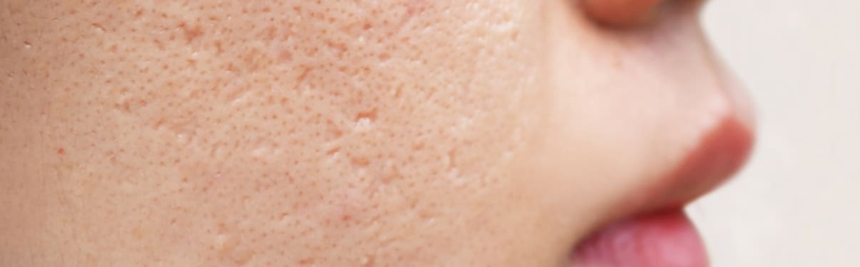 צלקות אקנה בפנים