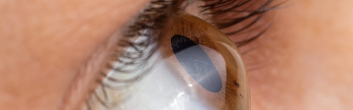 צילינדר בעין