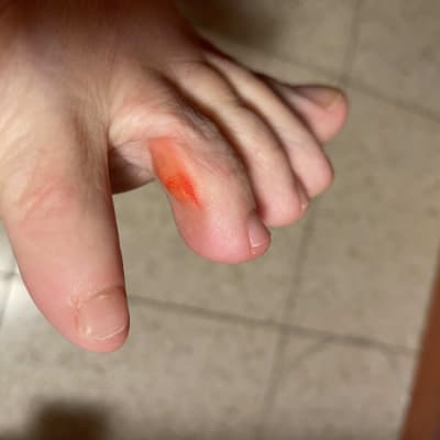 אצבע עם כתם צבע אדום על העור