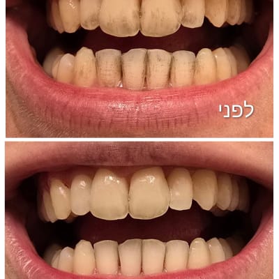 תמונת לפני ואחרי של שיניים לאחר טיפול