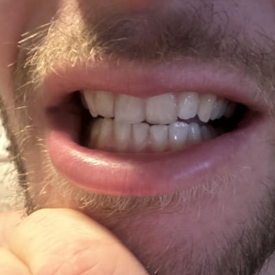 שיניים חשופות עם שפתיים פתוחות לבדיקה דנטלית