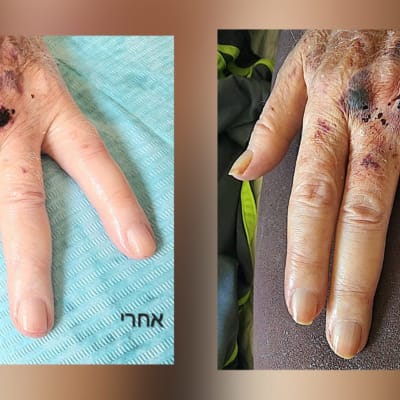 תמונות של ידיים עם סימנים לפני ואחרי טיפול