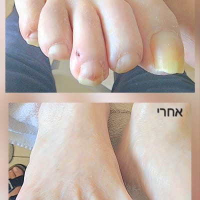 תמונות לפני ואחרי טיפול בציפורניים